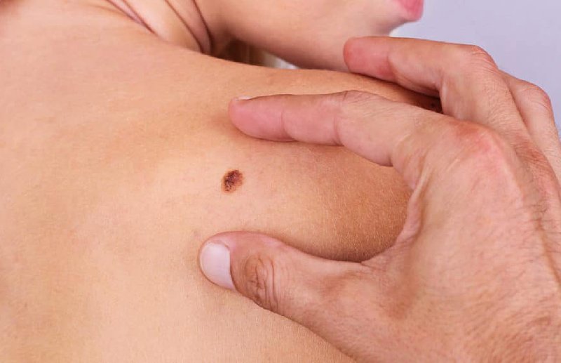 Czerniak, jak go rozpoznać i co robić?